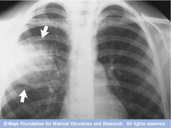 White Lung Syndrome Chest X-ray Mayo Clinic