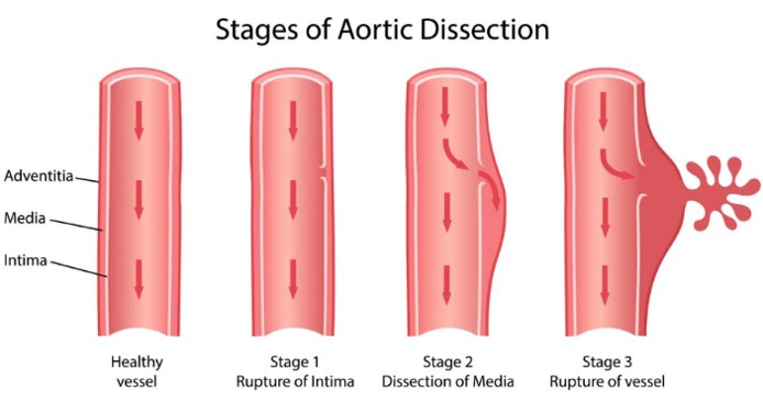 Vascular Inflammation Aortic Dissection