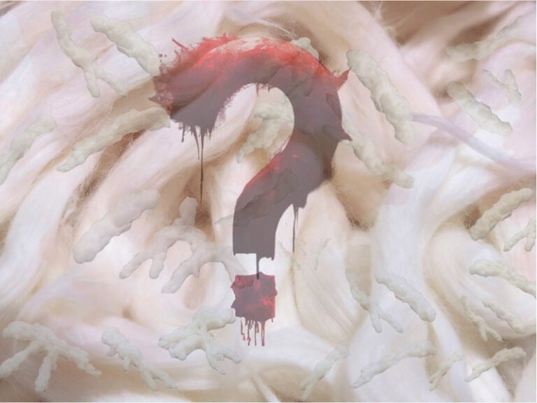White Rubbery Fibrous Clots Bruce Rapley Trozzi